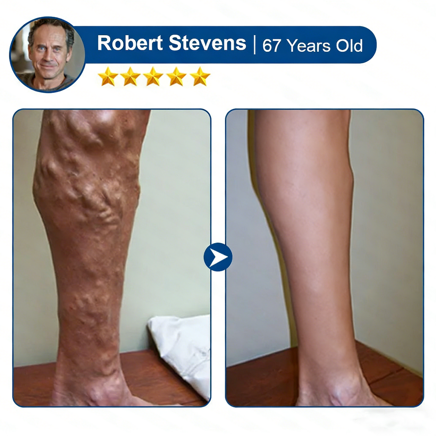 🌿 Hgfnvllc® Vein Contour Micro-Patch ✨ Diosmin & Hesperidin Leg Care Support