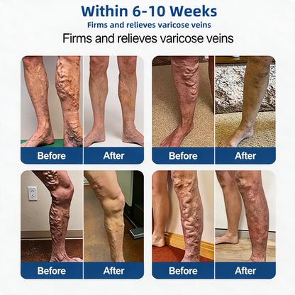 🌿 Hgfnvllc® Vein Contour Micro-Patch ✨ Diosmin & Hesperidin Leg Care Support