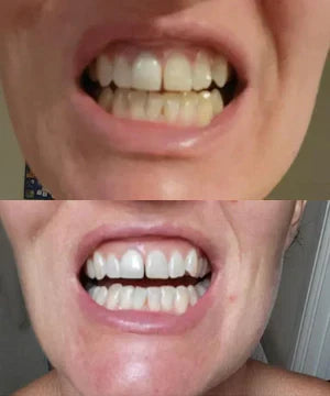 ✨Skavix Whitening Mouthwash – Stain Removal, Brighter Teeth & Fresh Breath