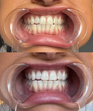 ✨Skavix Whitening Mouthwash – Stain Removal, Brighter Teeth & Fresh Breath