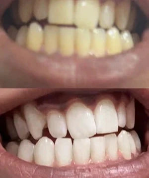 ✨Skavix Whitening Mouthwash – Stain Removal, Brighter Teeth & Fresh Breath